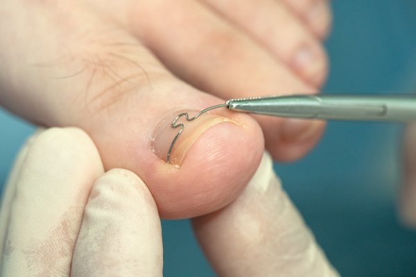 Onkolojik Ayak Bakımı